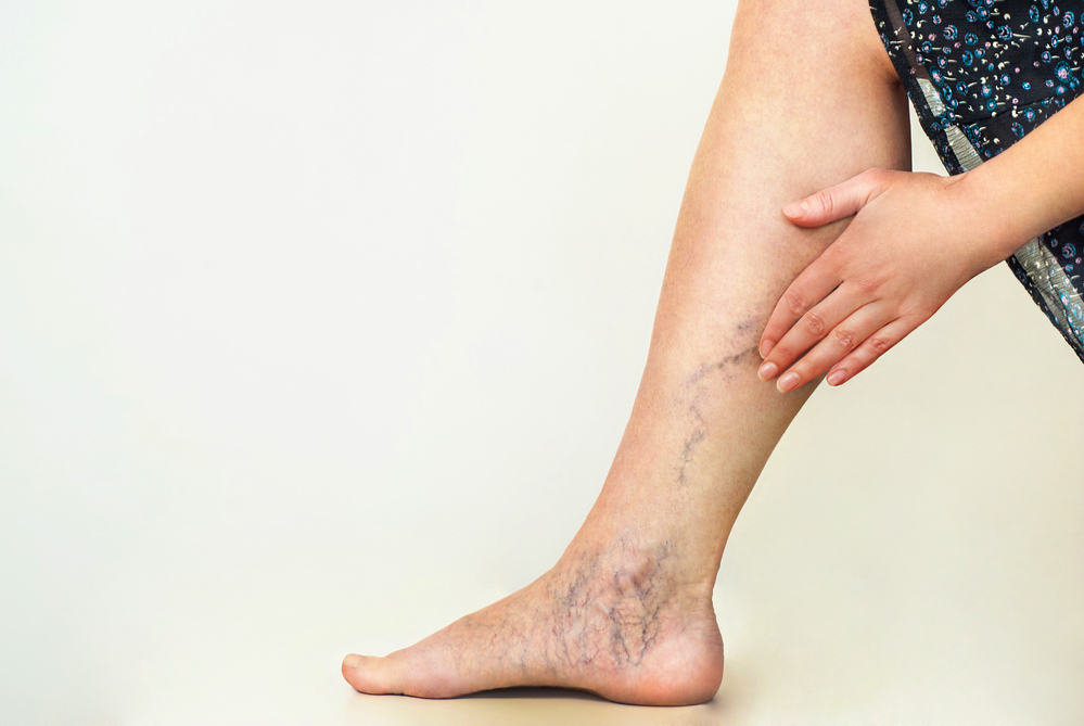 Causes and Prevention of Varicose and Spider Veins  
